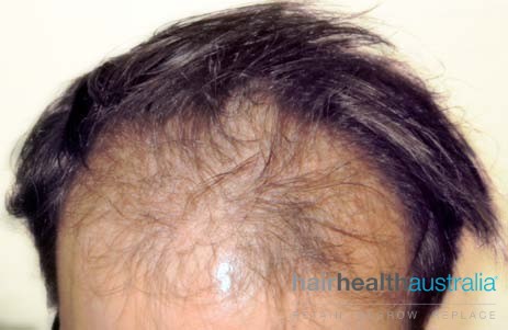 how to regrow postpartum hair loss